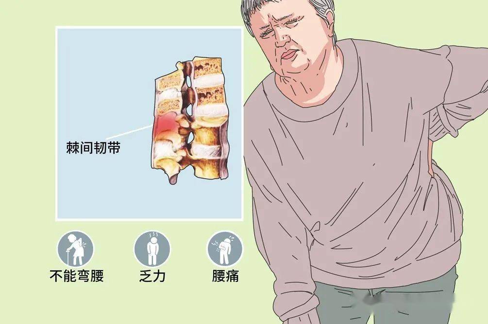 棘间韧带炎的典型症状图片