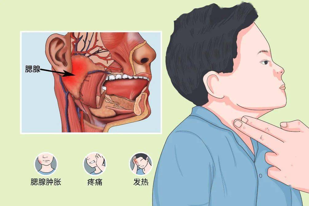 流行性腮腺炎:是由腮腺炎病毒引起,好发于儿童及青少年中常见的急性