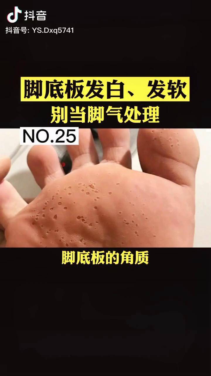 脚底板出现这种小孔很难受该怎么办窝状角质松解症脚气医学科普