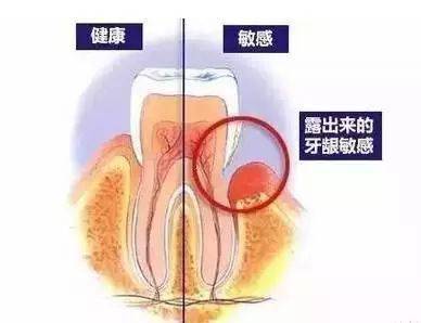 用什么可以把牙结石洗掉 a511edc100b8400f9d8de9a482427bc5.jpeg