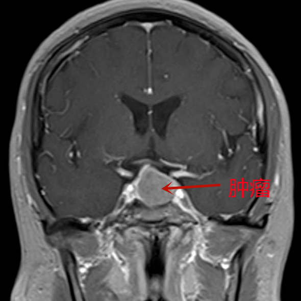 垂体瘤核磁共振图片图片