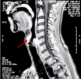 合并|规培医师视角下的多学科协作困难鼻胃管置入