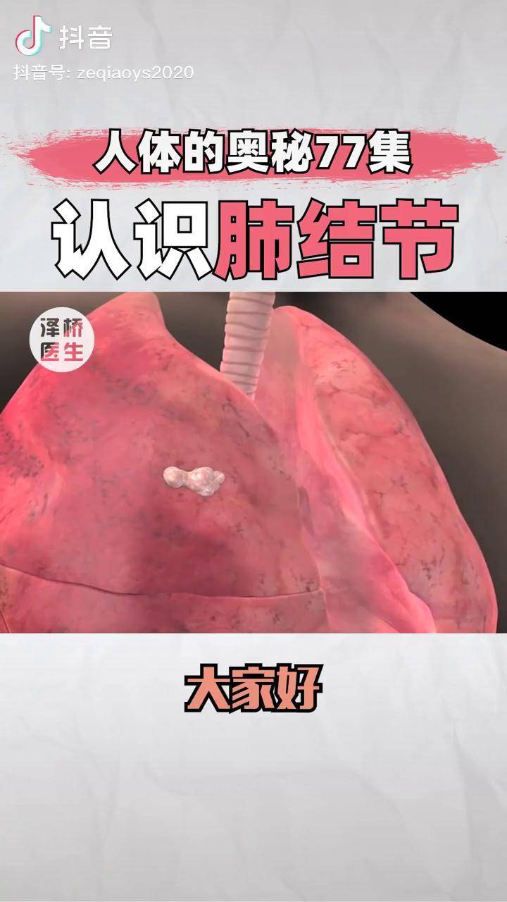 dou出新知正确了解肺结节,不要乱治疗,也不要害怕 科普