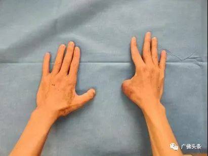 脚趾|“移花接木”成功了！脚趾移植变拇指