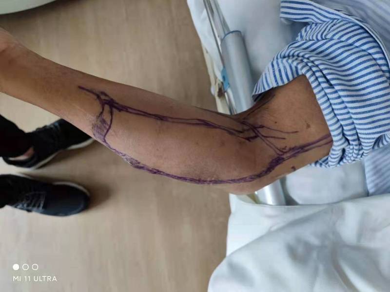 静脉|被医学耽误的“灵魂画手”！内科医生画瘘绘栓重启“生命线”