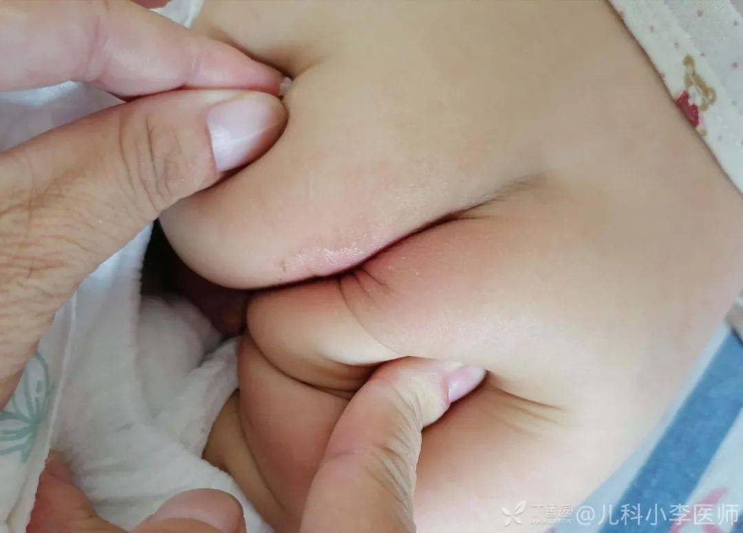 论坛|1 岁患儿高热 3 天，白细胞 2 万 7，这个病例很典型