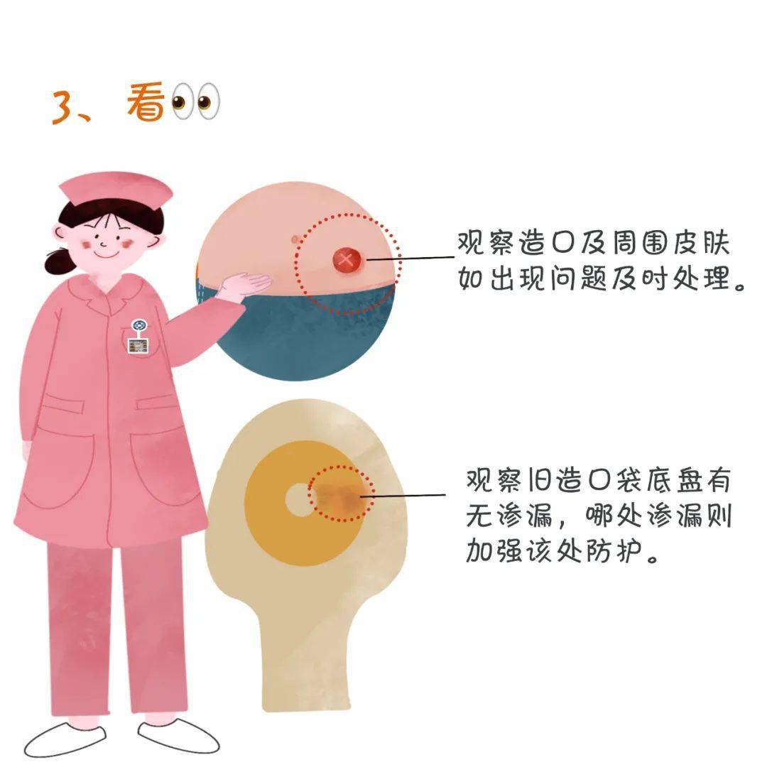 如何呵护身边的特殊人群——"肠造口人"?