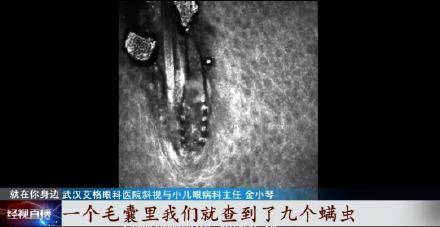 女童|10岁女童因眼睛奇痒拔光睫毛，医生：毛囊里长满螨虫