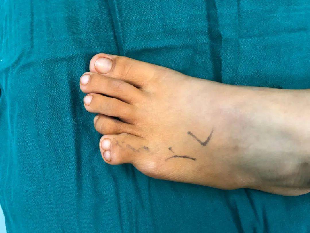 萧山8岁女孩左脚长6个脚趾,每天为穿鞋发愁,不敢跟小伙伴一起去玩水