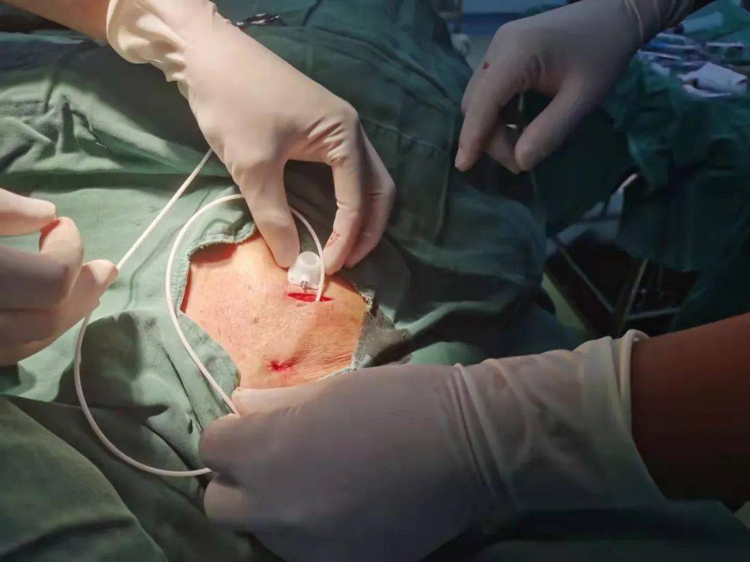 新技术丨我院成功开展首例静脉输液港植入术