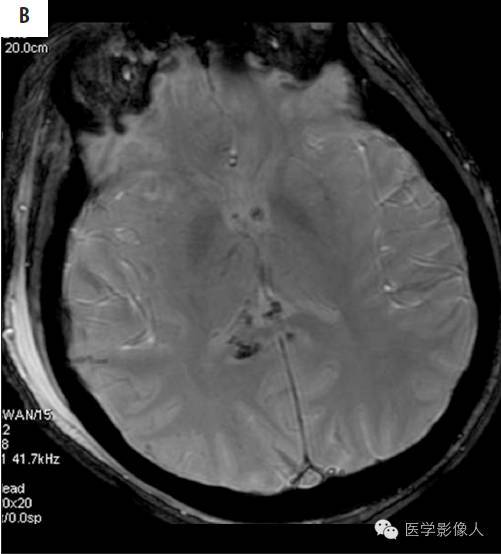 黄素环|脑内T2WI上低信号病变大致分为8大类【总结】