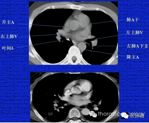 胸部正常ct解剖結構