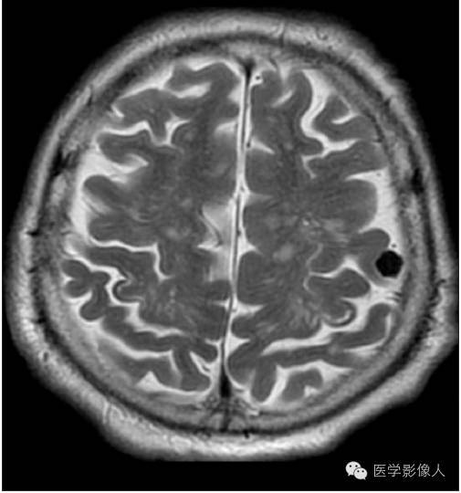 黄素环|脑内T2WI上低信号病变大致分为8大类【总结】