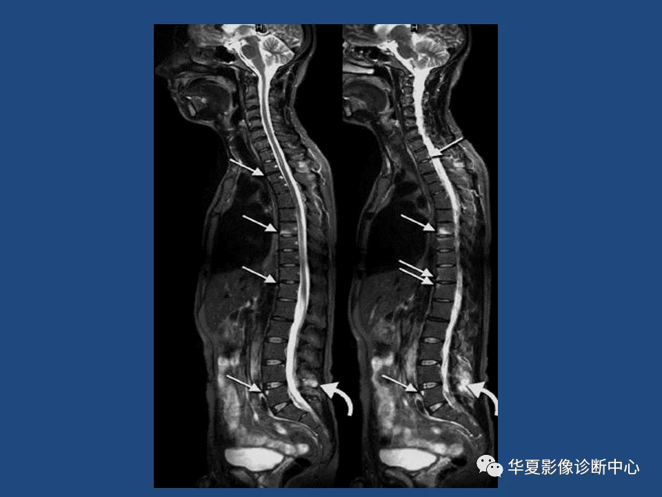 强直性脊柱炎影像诊断和鉴别诊断