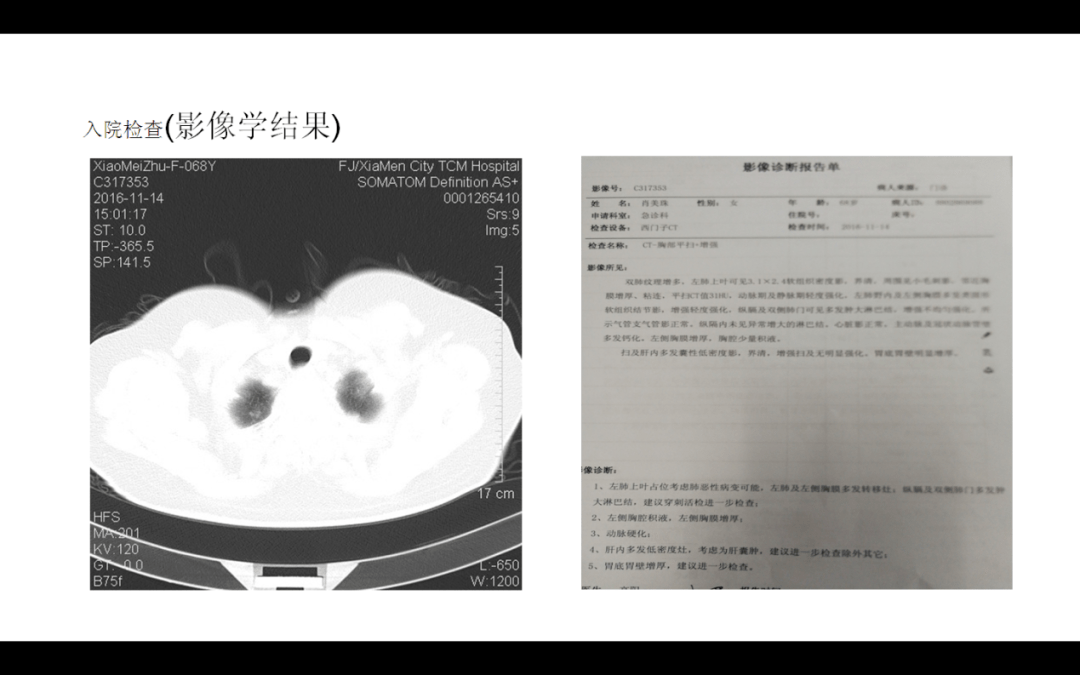 左肺恶性肿瘤[浸润性中-低分化腺癌,pt2n3m1cⅣb期,erbb2(exon20)