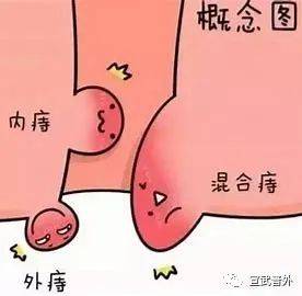 温水|世界镇痛日——痔疮疼痛难忍 温水坐浴可缓解