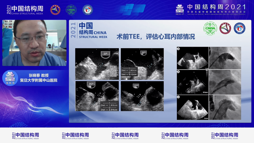 "左心耳封堵循证之夜"专题会中,特邀中国医学科学院阜外医院吴永健