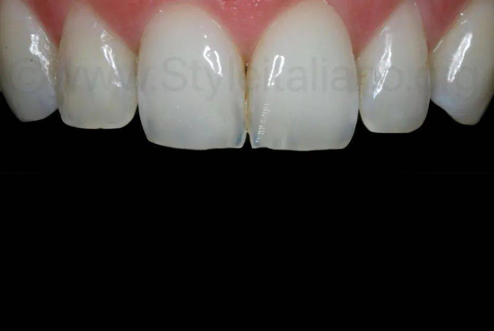 牙医学堂渗透树脂治疗前牙大面积釉质白斑