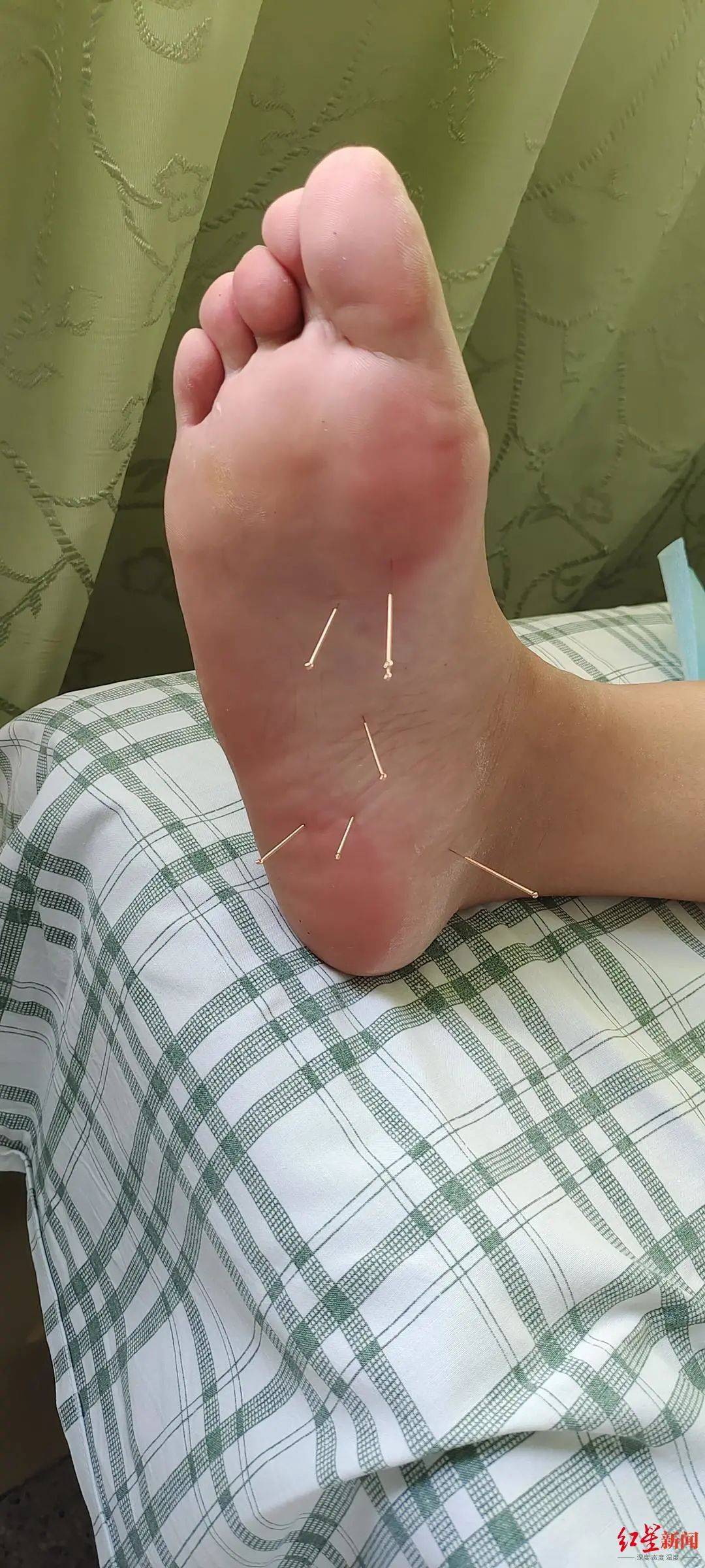 脚跟|注意！长期穿这类鞋易造成足底筋膜炎