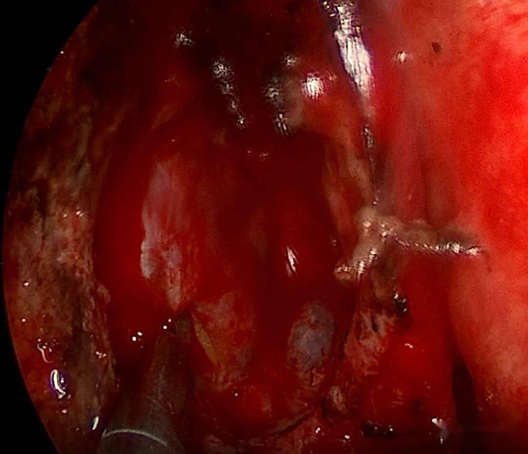 术中,切除部分中鼻甲,磨除右侧的钩突和筛泡,到右侧眼眶内侧壁,一并