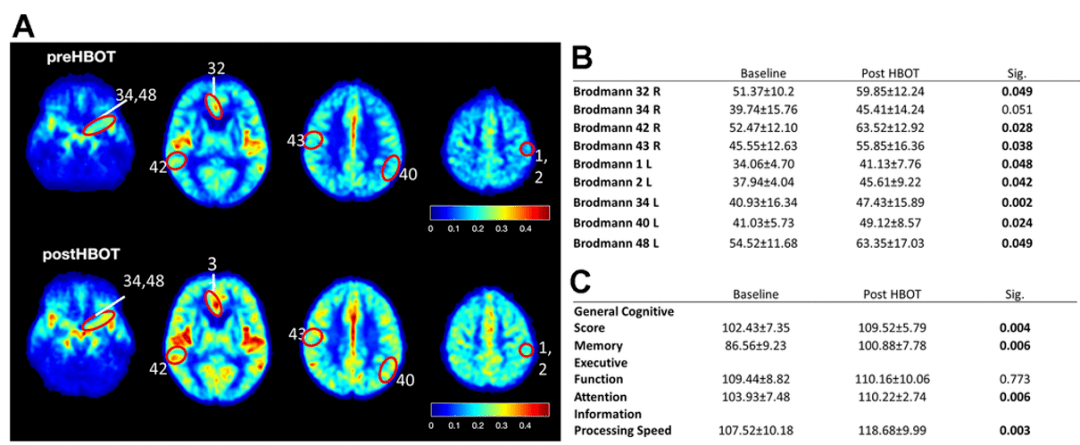高压氧治疗使老年患者的脑血流量和认知功能得到改善(图片来源:参考