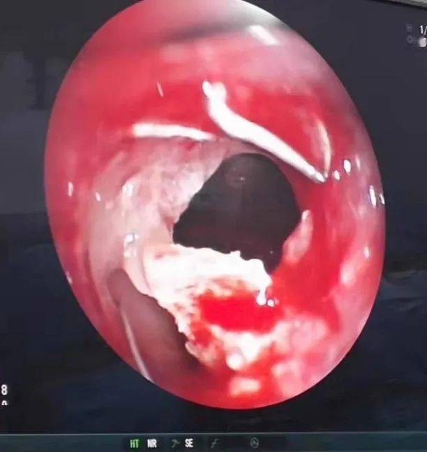 该患者因右肺下叶肺癌术后出现发热,气促,咳黄脓痰,胸片提示手术部位