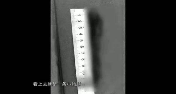 腊肠|阿姨腰痛十来年，体内竟长出一条“广式腊肠”险截瘫！医生紧急提醒