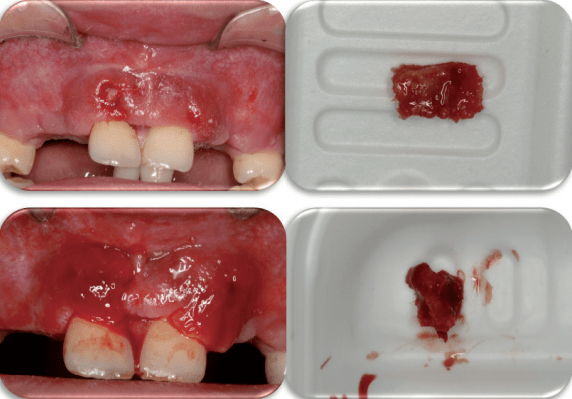 先天性前牙缺失髂骨移植后种植修复一例