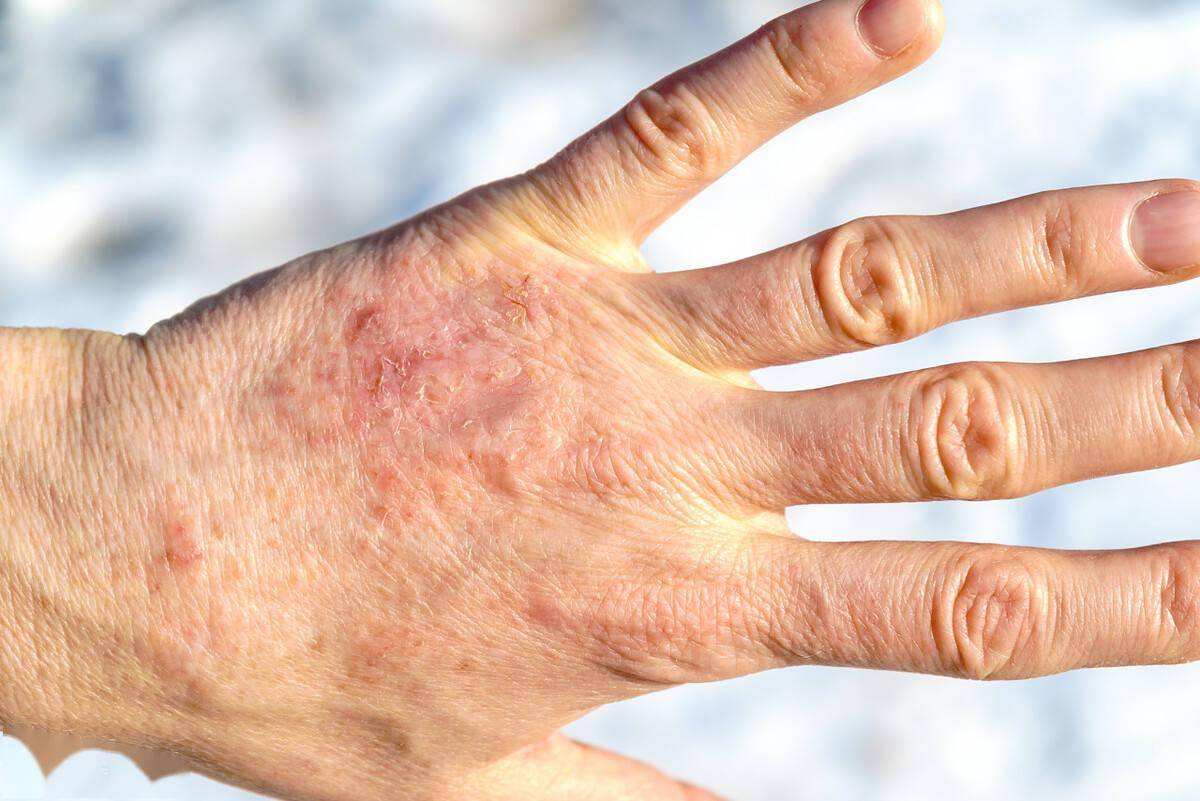 现实生活中,神经性皮炎多数由于患者长期过度兴奋,过度抑郁或者神经