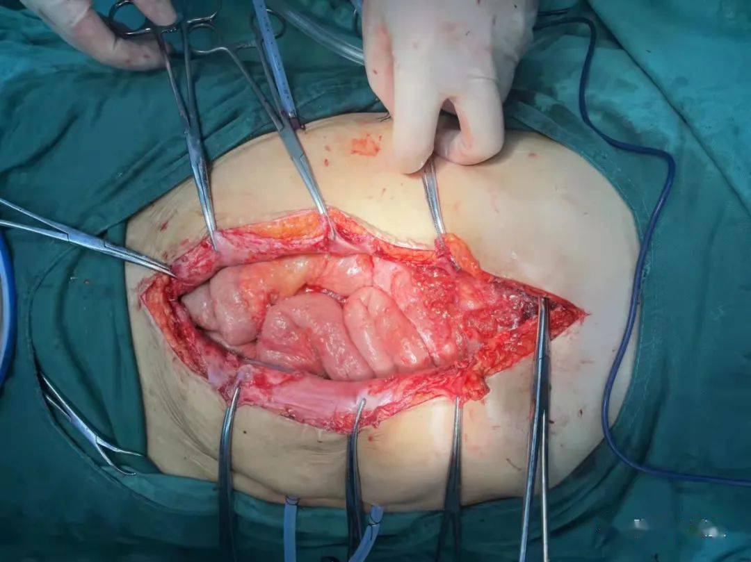 腹腔粘液瘤图片