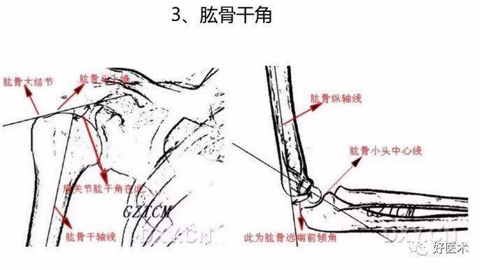 肱骨前倾角图片