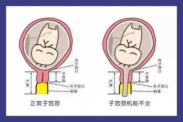 這個原因不容忽視!_宮頸