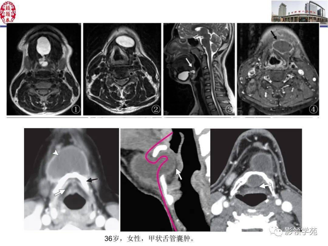 舌口底影像解剖及常见疾病影像诊断