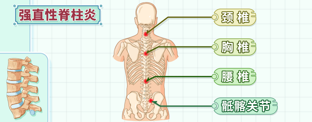 强直性脊柱炎位置图片