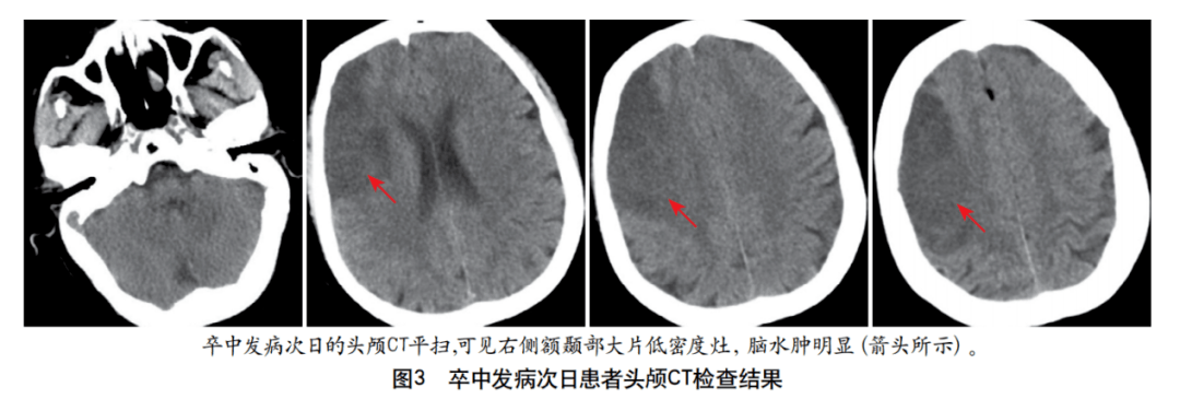 综合征|以多流域脑梗死为特征的肺癌继发特鲁索综合征1例并文献复习