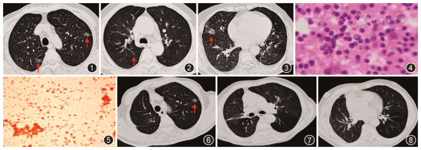 病例报告以反复淡黄色澄清胸腔积液为特征的肺癌术后迟发性乳糜胸一例