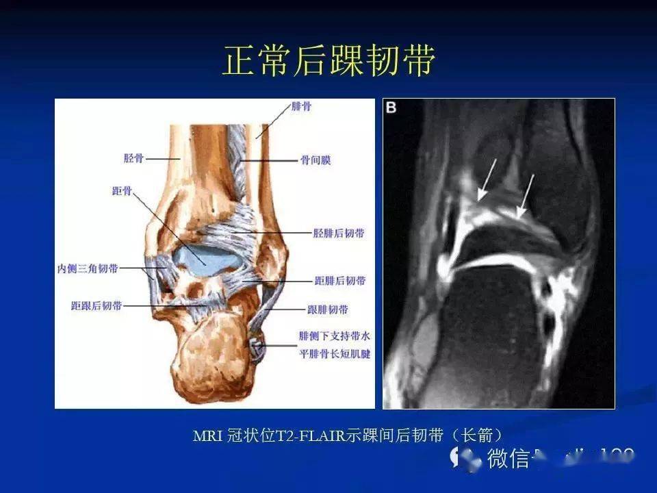 踝关节mri解剖及常见病变踝关节运动损伤mr诊断踝关节x片的读片方法