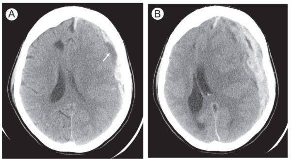 进行|脑出血CT的9大“陷阱”，稍不留神就会误诊