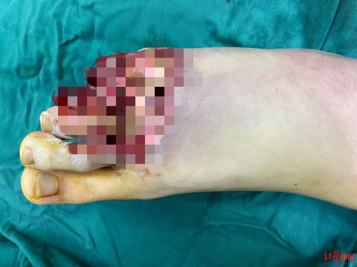 伤情|烫伤变冻伤！17岁男生用“迅速降温剂”降温，险被截趾