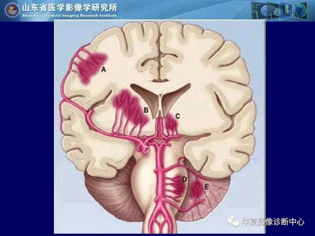 诊断|缺血性脑血管病的影像诊断