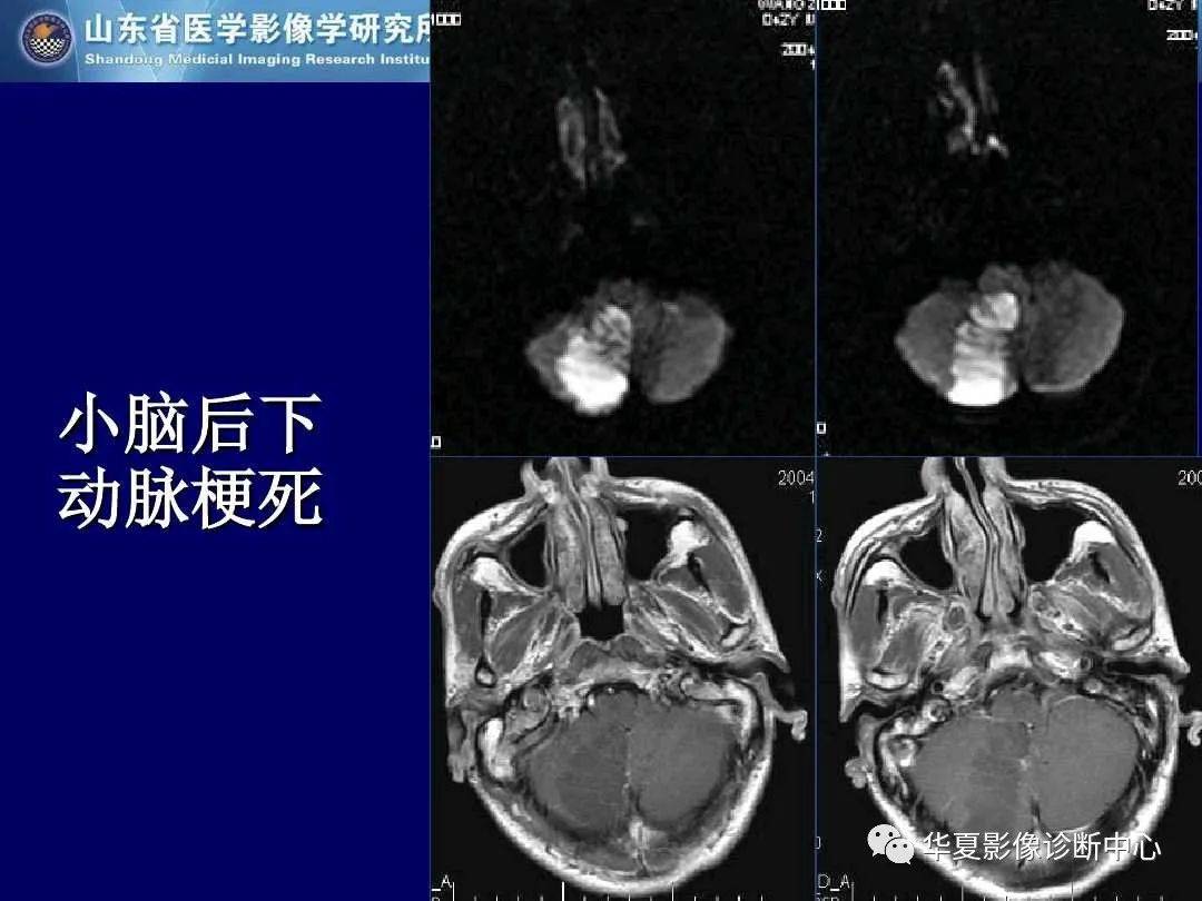 诊断|缺血性脑血管病的影像诊断