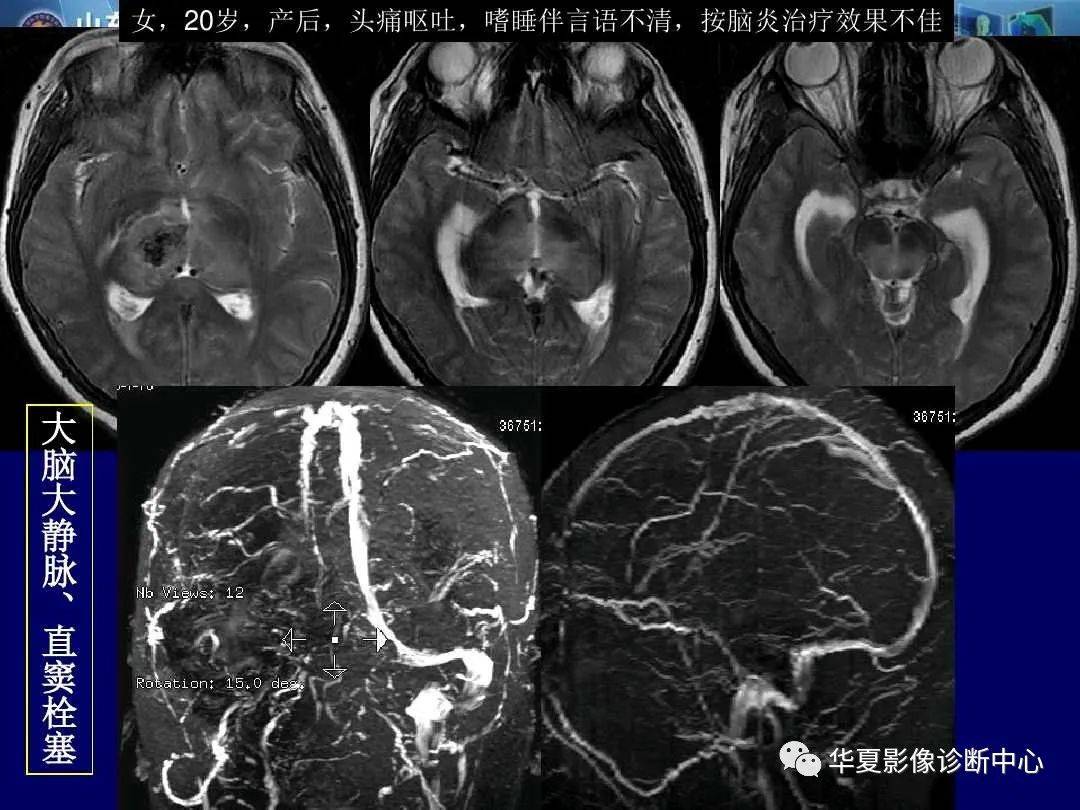 诊断|缺血性脑血管病的影像诊断