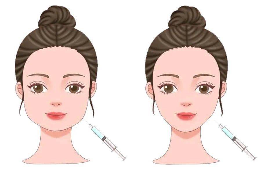 肉毒毒素玻尿酸水光针微整形风行科学避坑方能安全变美