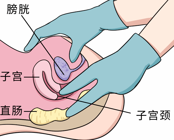 母胎solo还需要做这项妇科检查呀?