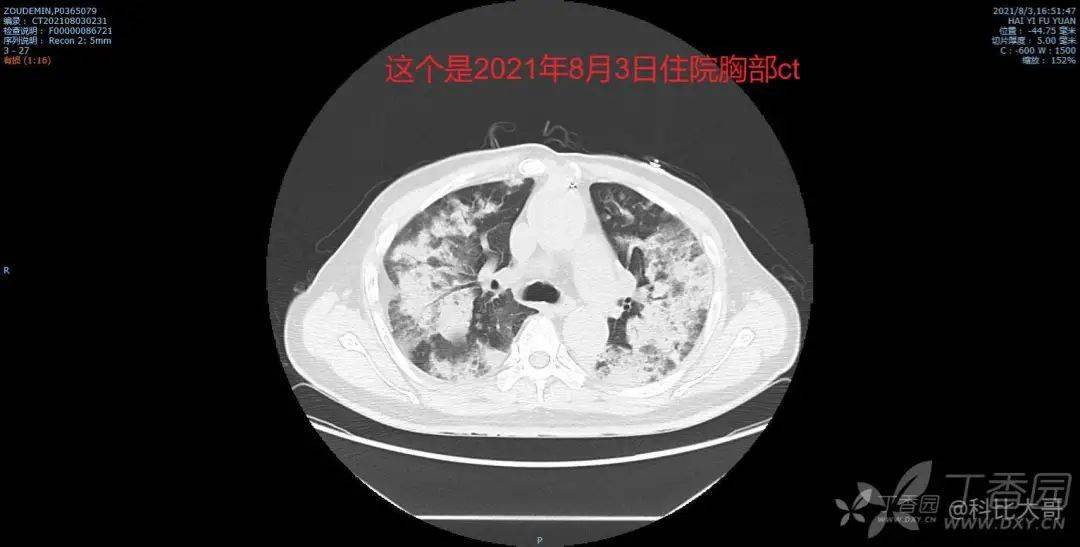 73歲患者咳白色泡沫痰肺部感染找不到致病菌用藥也無好轉問題竟在