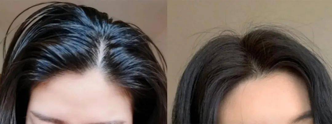 挑战5天不洗头韩国变态洗发水斩获4大国际专利头皮协会认证控油去屑