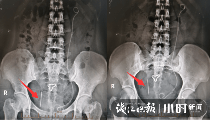 绣花针|一根“绣花针”竟在身体里藏了二十多年，医生：运气太好了