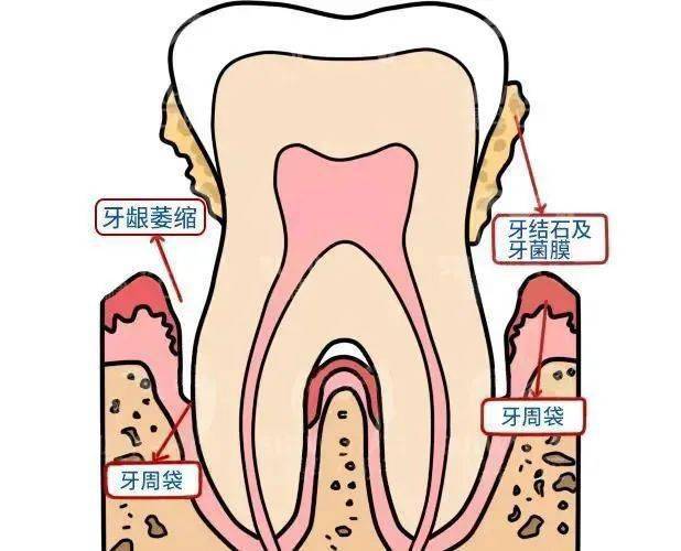 被迫在岗位歇菜得不到及时清洁的牙工形成牙周袋龈沟变得又深又宽然后