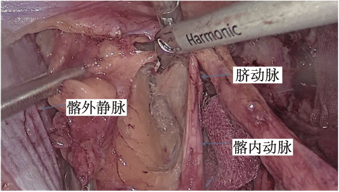 葉凱腹腔鏡直腸癌側方淋巴結清掃解剖與筋膜認識腹腔鏡胃腸手術筆記第