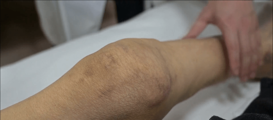 男子|被“石头”啃掉膝关节，男子几乎无法直立行走